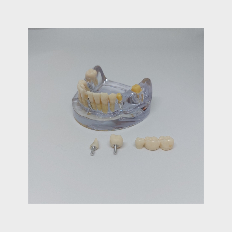 Implantat/Bro Studiemodel 